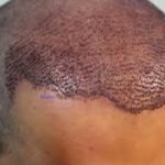 Hair Transplant