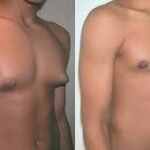 Gynecomastia